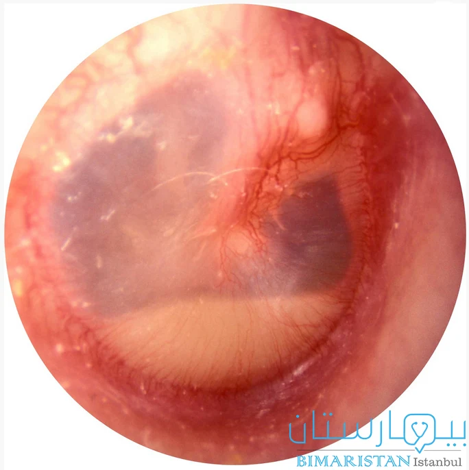 middle ear infection pictures 