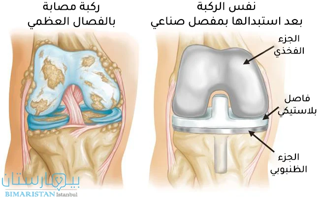 Severe osteoarthritis of the knee can be treated by replacing the affected knee joint with an artificial joint