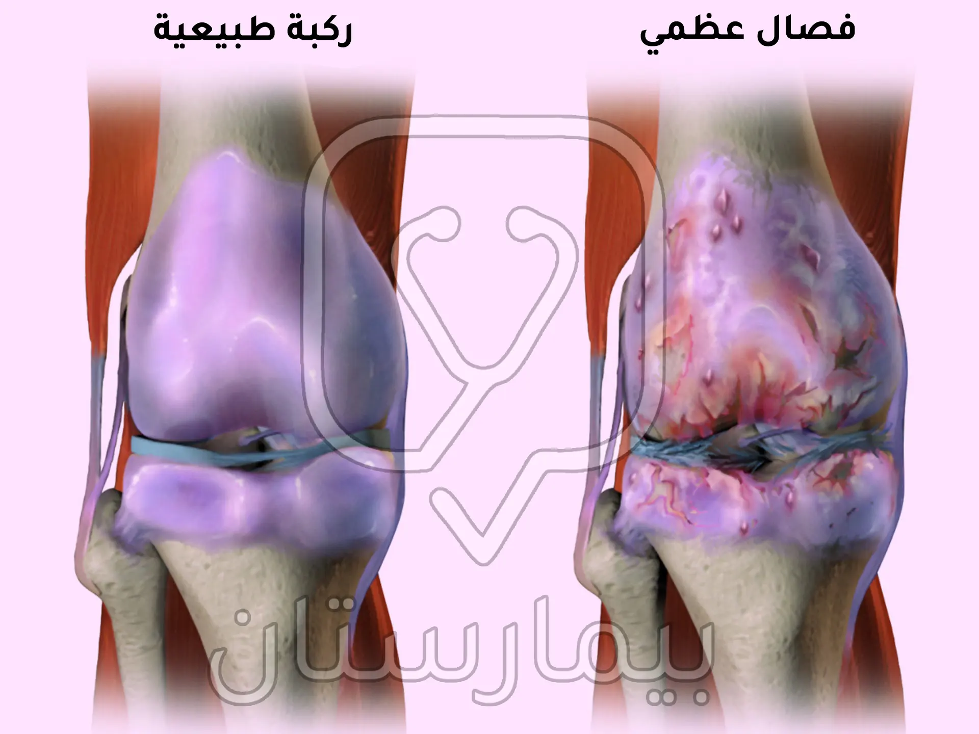 Osteoartrit, eklem kıkırdağında ilerleyici hasar ve alttaki kemiğin dejenerasyonu ile karakterizedir.