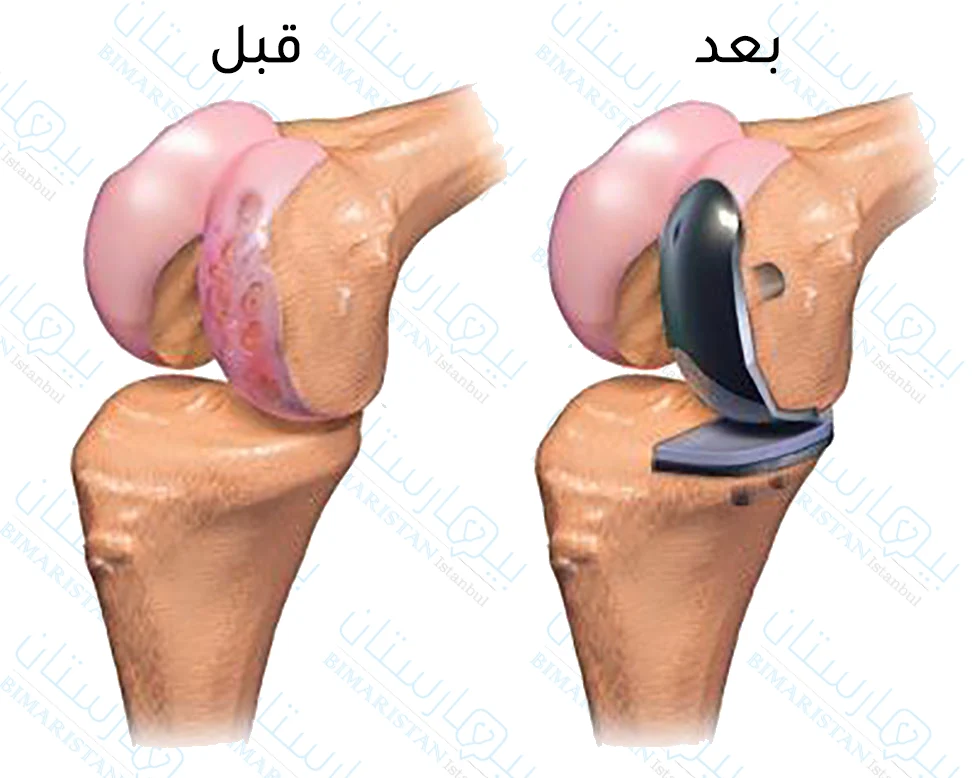نتيجة عملية تبديل مفصل الركبة الجزئي والفرق بين قبل وبعد العملية