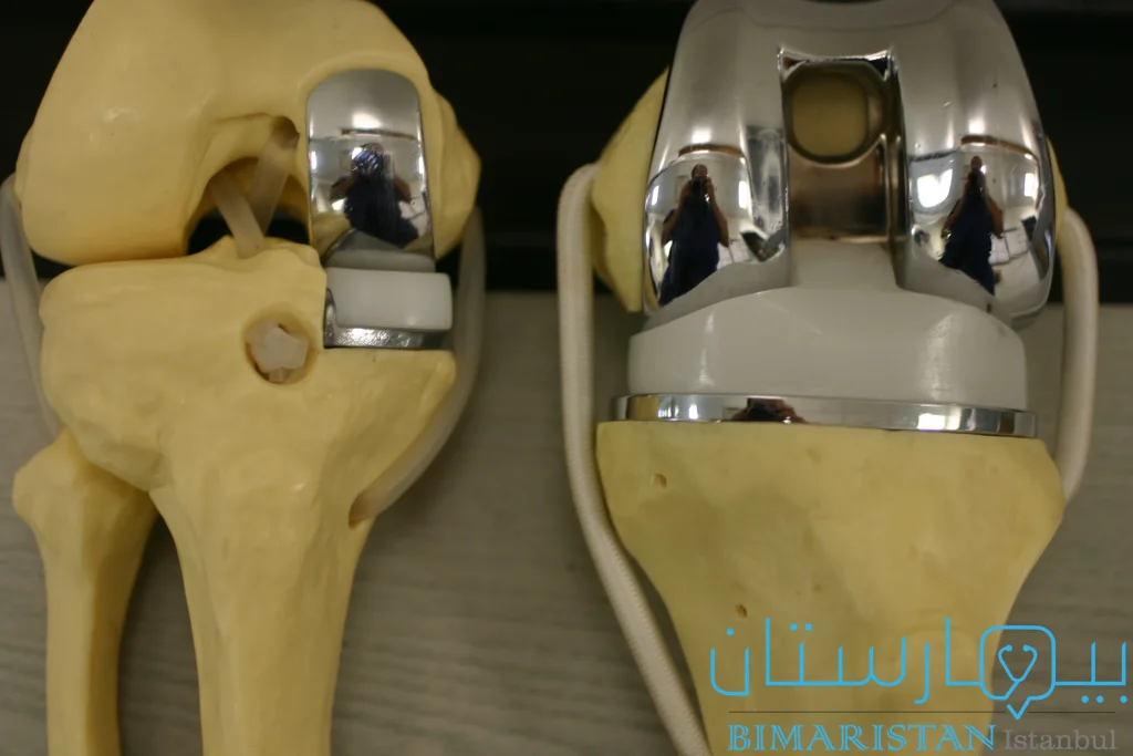Comparison between the artificial joint used in total knee joint replacement surgery and partial joint replacement surgery