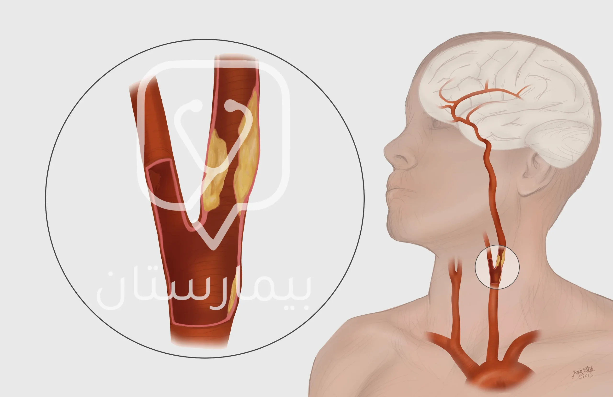 A picture showing the formation of atherosclerosis that leads to narrowing of the carotid artery, which reduces blood flow to the brain, causing dizziness (it may, in rare cases, be one of the causes of dizziness in women)