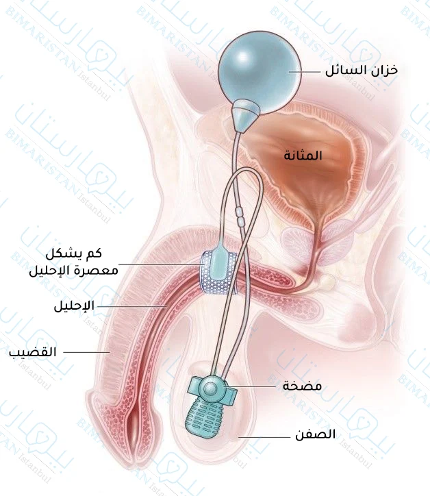 An image showing the surgical treatment of neurogenic bladder through the installation of an artificial urethral sphincter