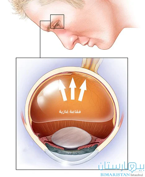 Image showing the head-stopping position when gas is used in the treatment of retinal detachment