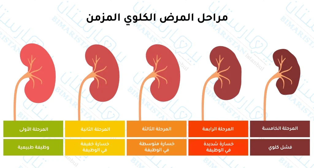 A picture of the stages of chronic kidney disease