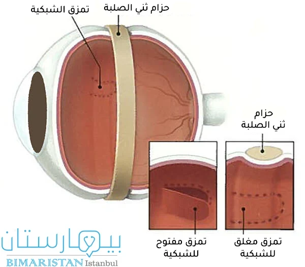 Skleral fleksiyon yoluyla retina dekolmanı tedavisini gösteren görüntü