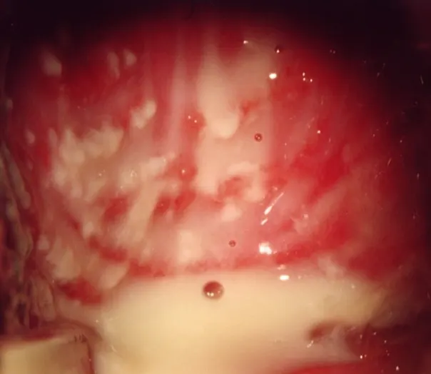 A picture showing the white vaginal secretions when infected with fungal vaginitis, and the condition calls for treatment of vaginitis for married women
