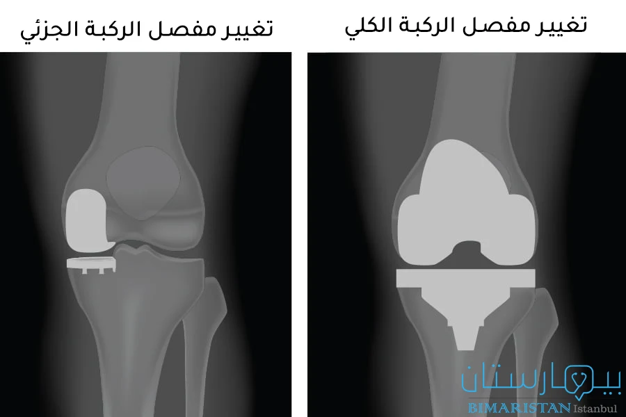 صور بالأشعة السينية تقارن بين المفصل الصناعي الجزئي للركبة والمفصل الصنعي الكامل