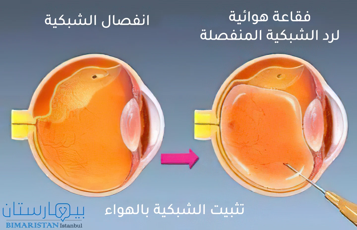 An image showing the treatment of retinal detachment by air fixation of the retina