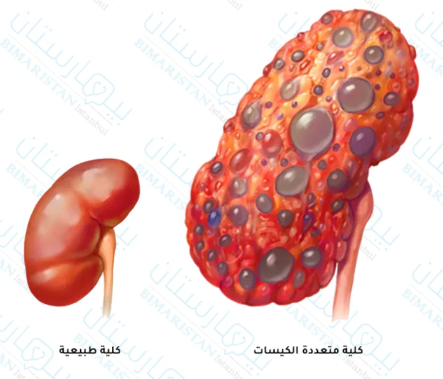 A picture of a polycystic kidney that may cause symptoms of early renal failure