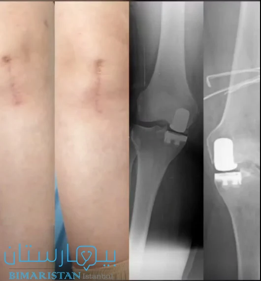 عملية تغيير مفصل الركبة الجزئي ثنائي الجانب لمريضة عبر مركز بيمارستان، نلاحظ الشق الجراحي الصغير