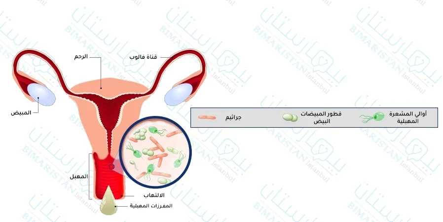 صورة توضح الأحياء الدقيقة المسببة لالتهاب المهبل للمتزوجات