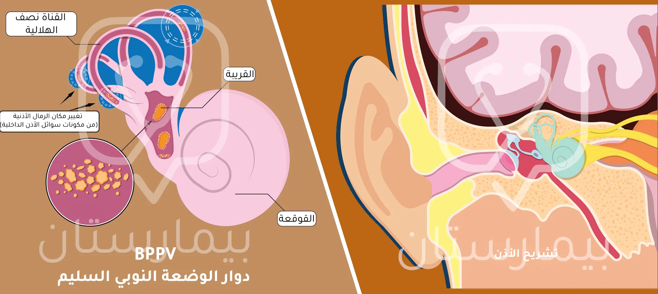 صورة توضح كيفية حدوث دوار الوضعة النوبي السليم (من أسباب الدوخة عند النساء) وكيف تتحرك الجزيئات خارج موقعها في الأذن الداخلية