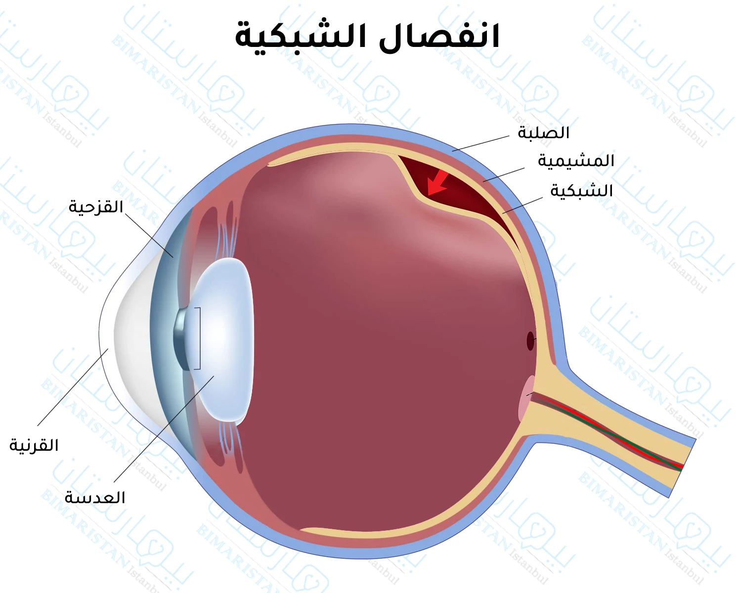 An image showing a detached retina