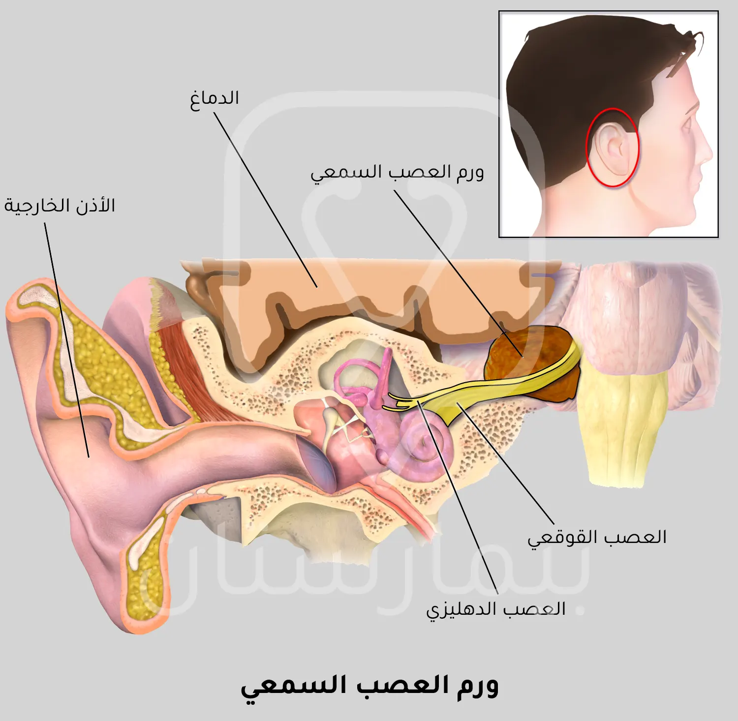 An image showing the location of the acoustic neuroma (a cause of dizziness in women)