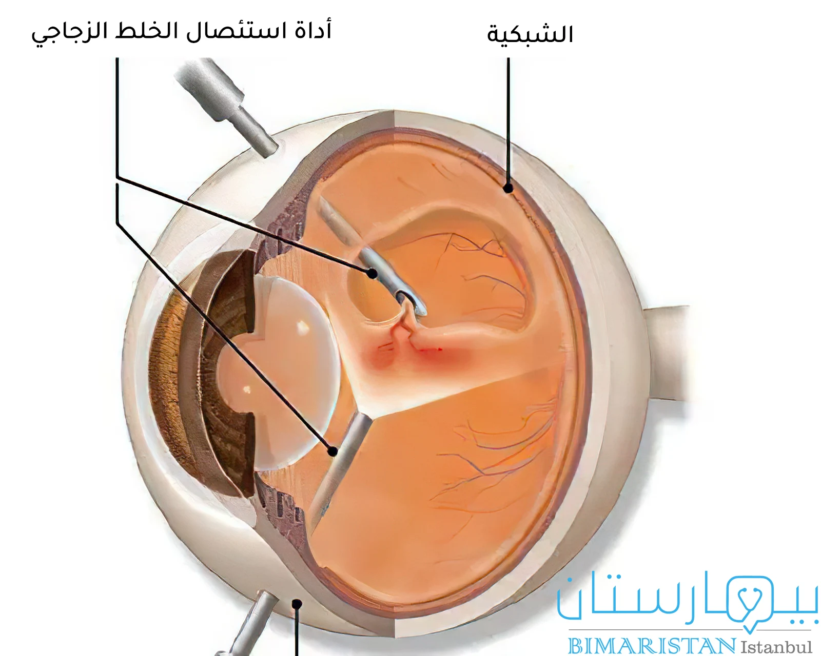 Vitrektomi ile retina dekolmanı tedavisini gösteren resim