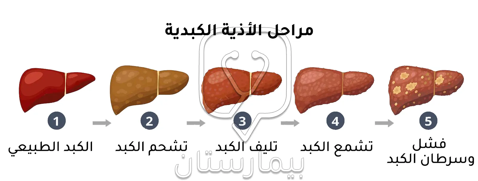 An image showing the stages of liver damage that ends in cirrhosis and thus transferring the patient to liver transplantation