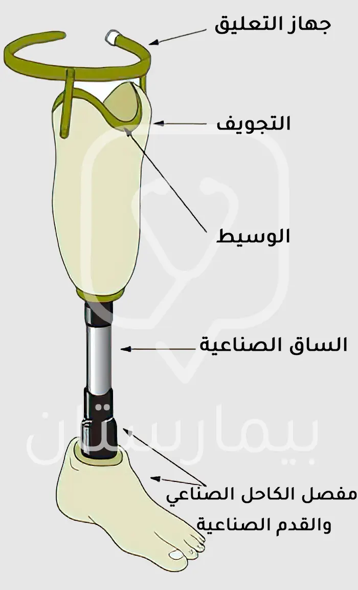 A picture showing the parts of the prosthetics used when installing the prosthetics