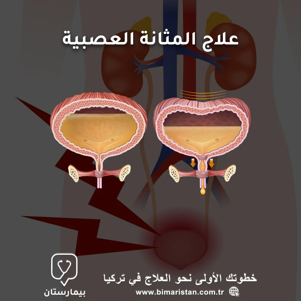 Cover image about neurogenic bladder treatment