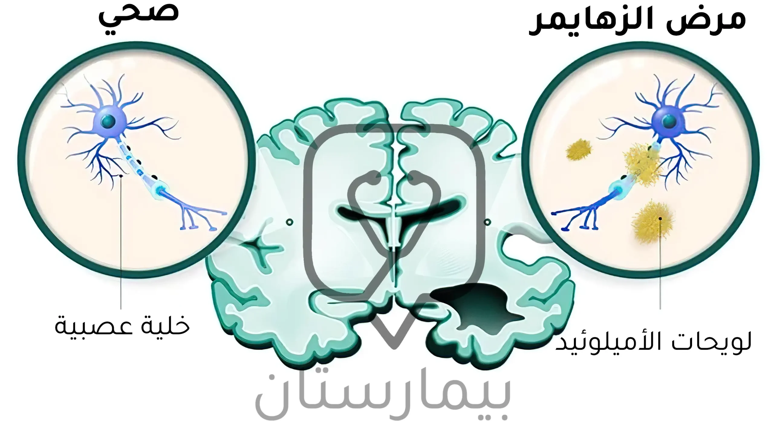 صورة توضح أسباب مرض الزهايمر (ترسب لويحات الأميلوئيد)