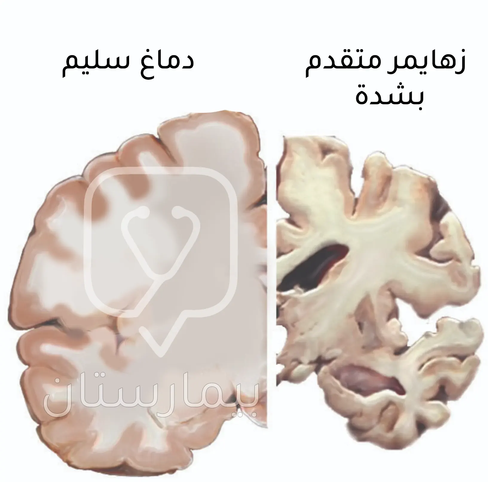 صورة توضح ضمور المادة الدماغية بسبب مرض الزهايمر