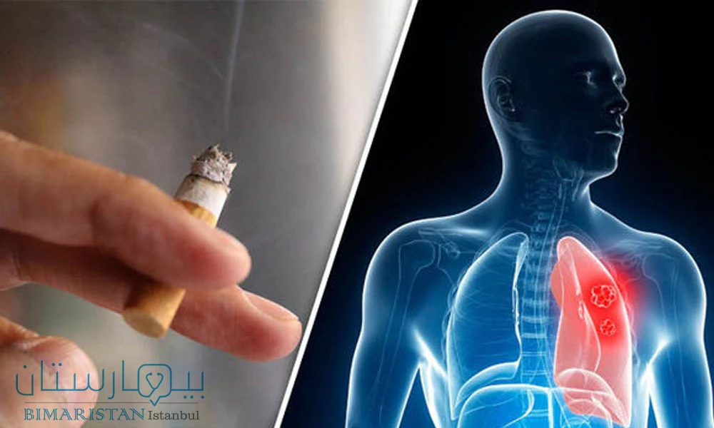 يتساءل العديد من الناس حول علاقة سرطان الرئة والتدخين