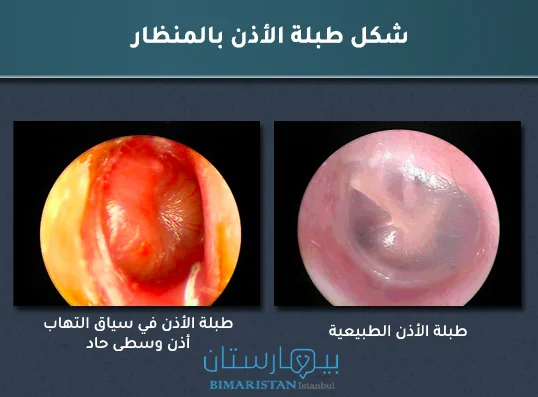 صور مأخوذة بالمنظار توضح الفرق بين طبلة الأذن الطبيعية والطبلة في سياق التهاب الأذن الوسطى