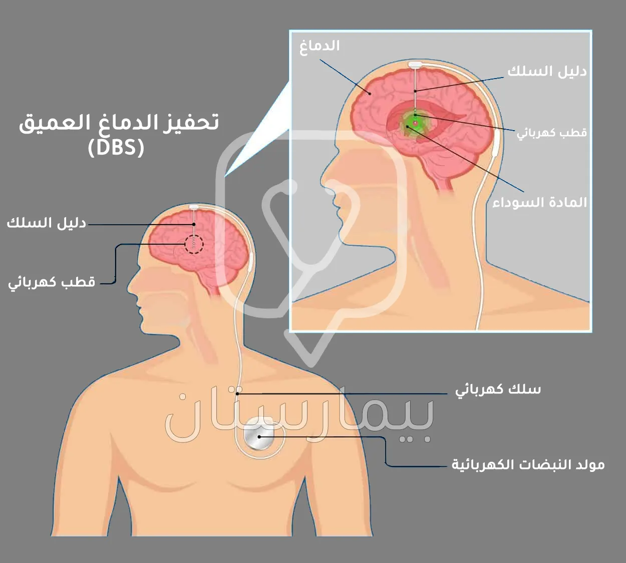 Derin beyin stimülasyonu yoluyla Parkinson hastalığının tedavisinden bahseden bir görüntü