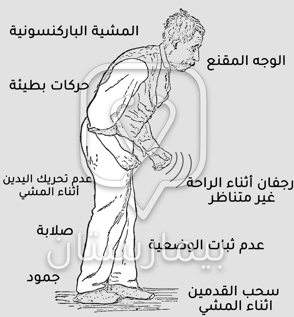 Picture showing the symptoms of Parkinson's disease