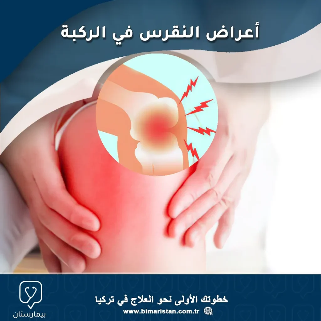 Symptoms of gout in the knee