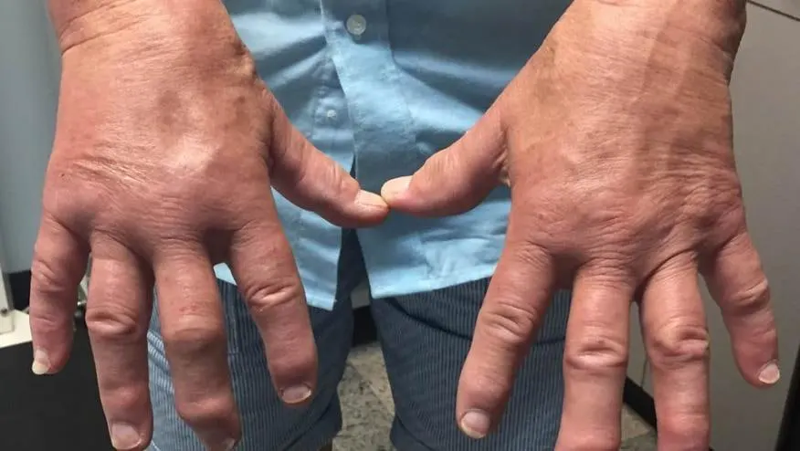 Bu fotoğraf, jinekolojik artrit semptomları olan bir hastanın şişmiş elini göstermektedir.