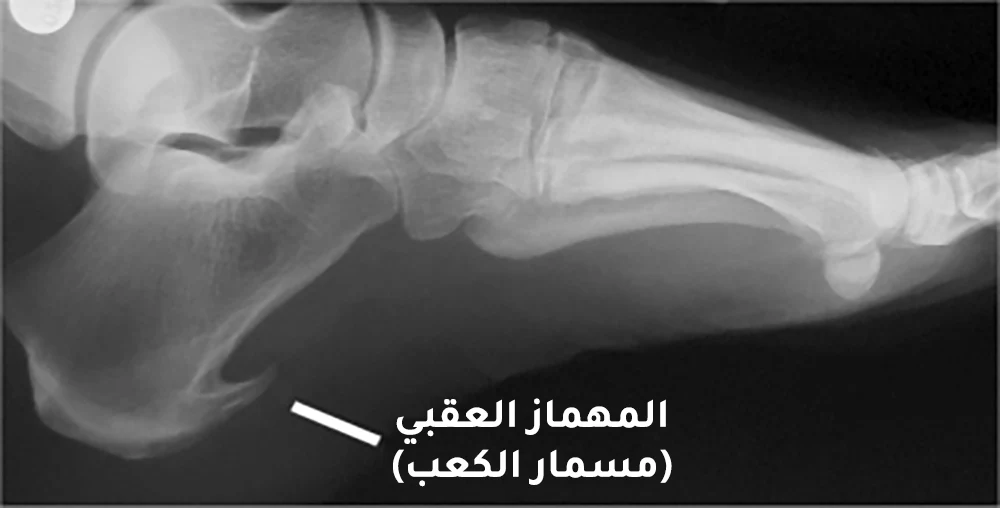 Radiograph showing the heel spur
