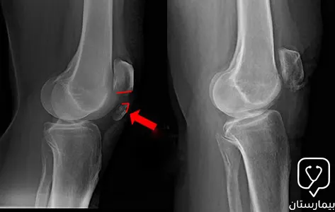 An X-ray image of a fracture in the patella, which is the most common type of knee fracture