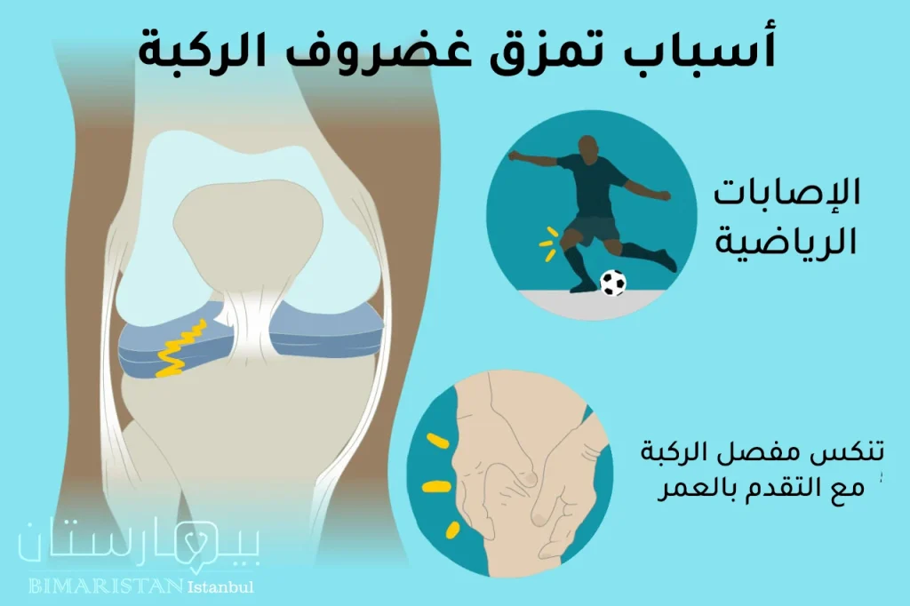 Causes of torn meniscus 