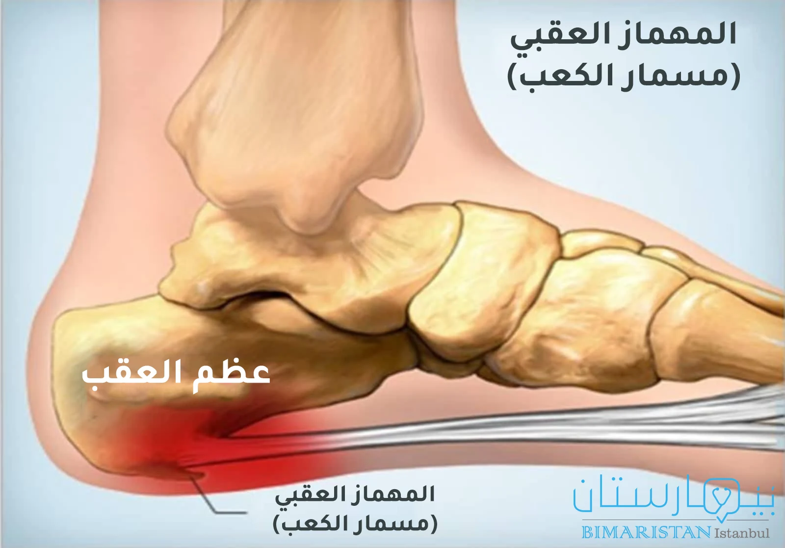 Image showing the formation of the heel nail on the heel bone and its irritation to the adjacent tissues