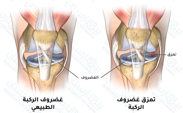 Torn meniscus pictures