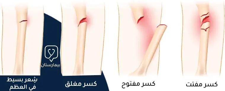 Types and forms of knee fractures