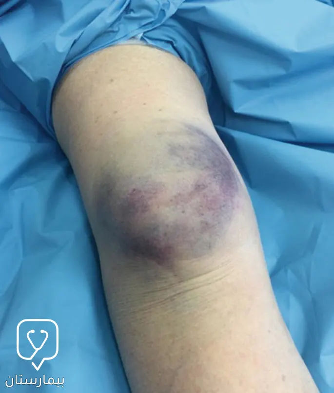 Extensive bruising around the knee of a patient who had an accident that left him with knee fractures