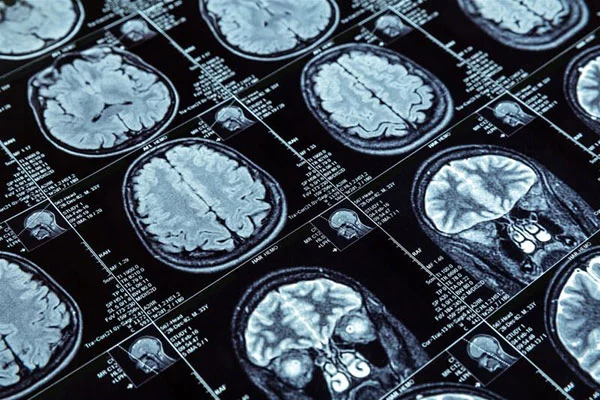 Neurosurgery at the Private Medicine Hospital in Istanbul