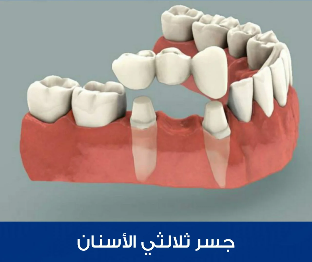 Compensation for a missing tooth with a dental bridge