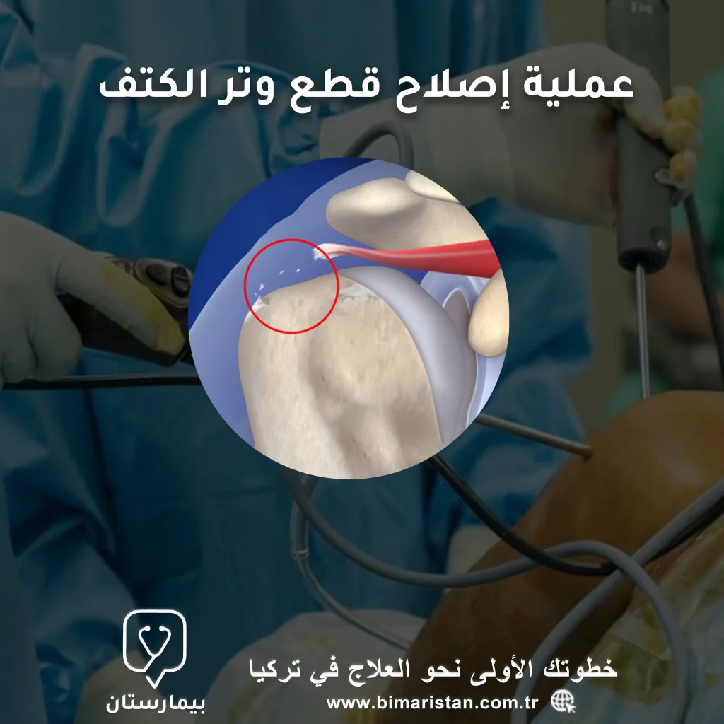 Shoulder tendon cutting surgery in Turkey