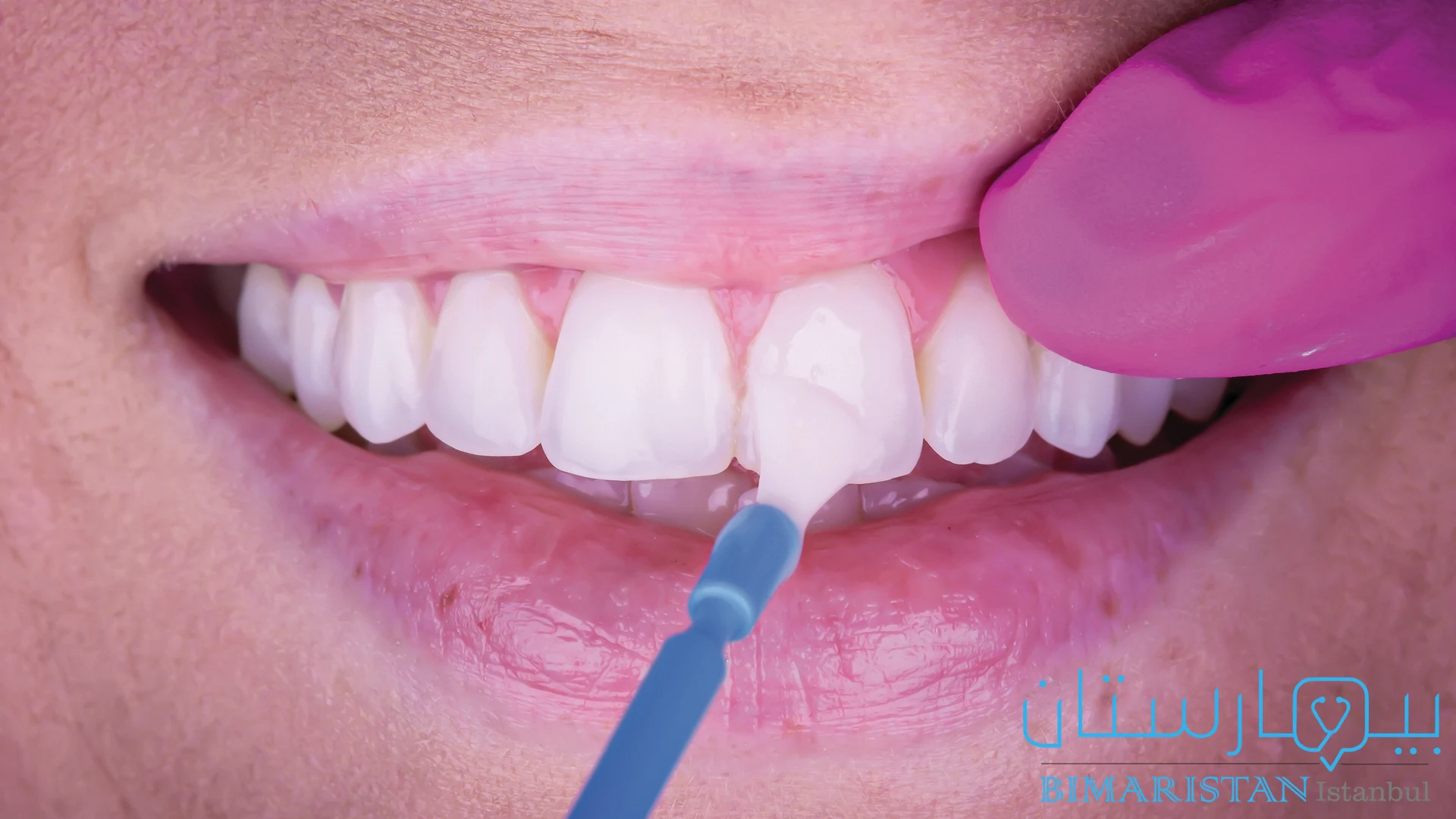 Florür vernik tedavileri bir diş muayenehanesinde profesyonelce uygulanmalıdır.
