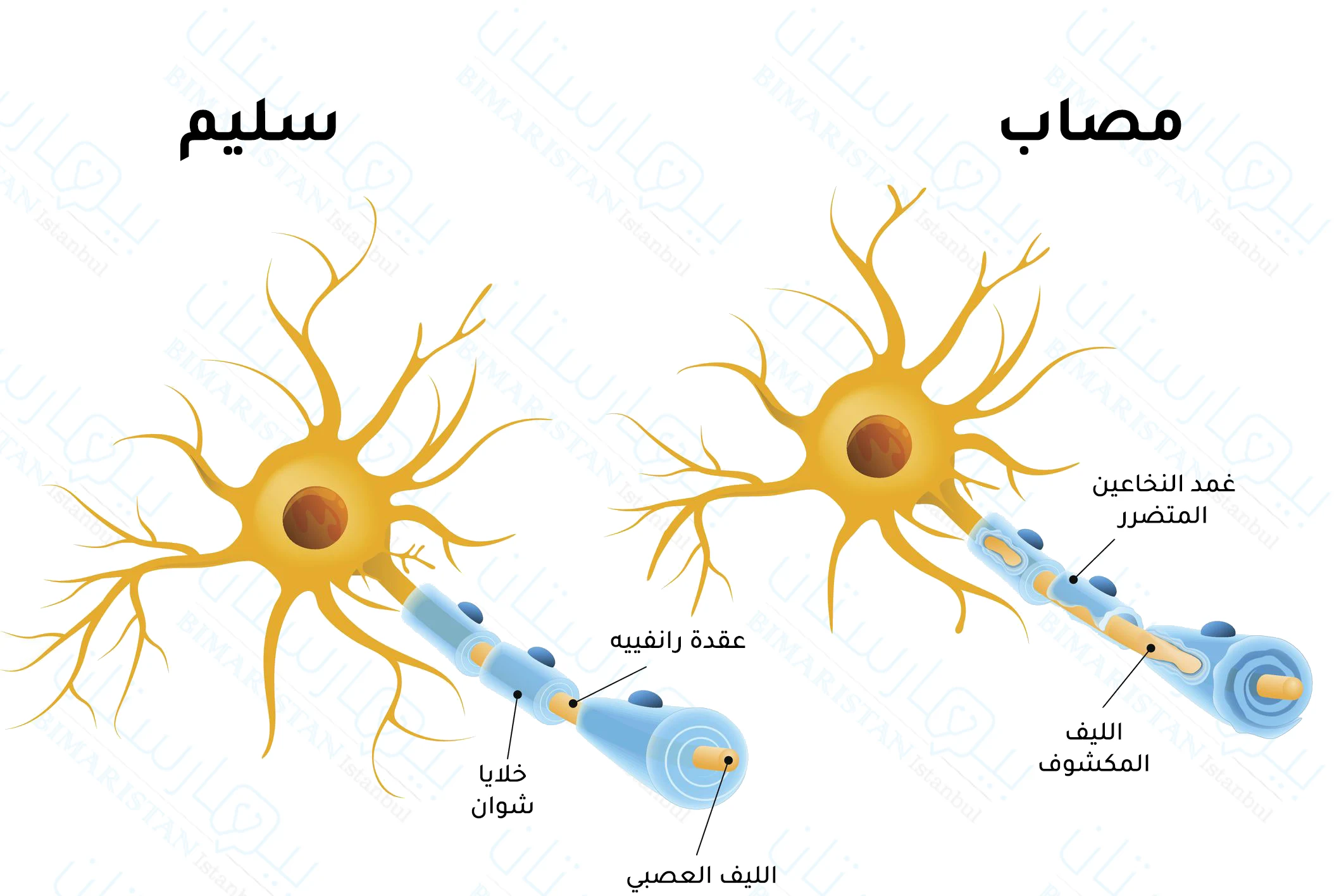 صورة توضح آلية حدوث التصلب اللويحي وكيف أن مناعة الجسم تهاجم أغماد الألياف العصبية