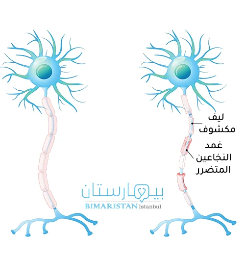 Image showing damage to the nerve fiber sheath in multiple sclerosis