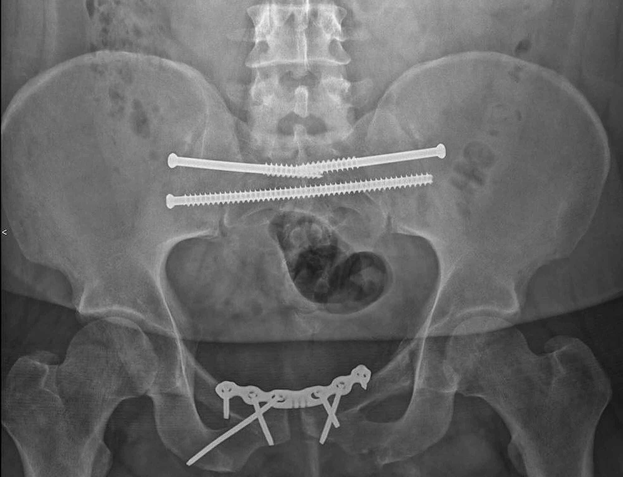 X-ray image to stabilize the pelvis from the inside in the event of a pelvic fracture