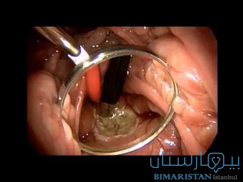 A picture showing the operation of the nasal septum