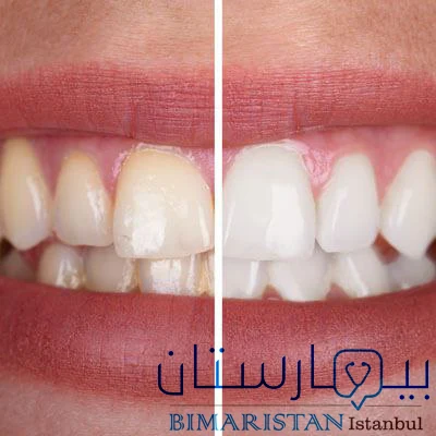 تظهر الصورة اختلاف لون الأسنان بين الأصفر البرتقالي قبل التبييض على اليسار واللون الأبيض الناصع بعد التبييض على اليمين