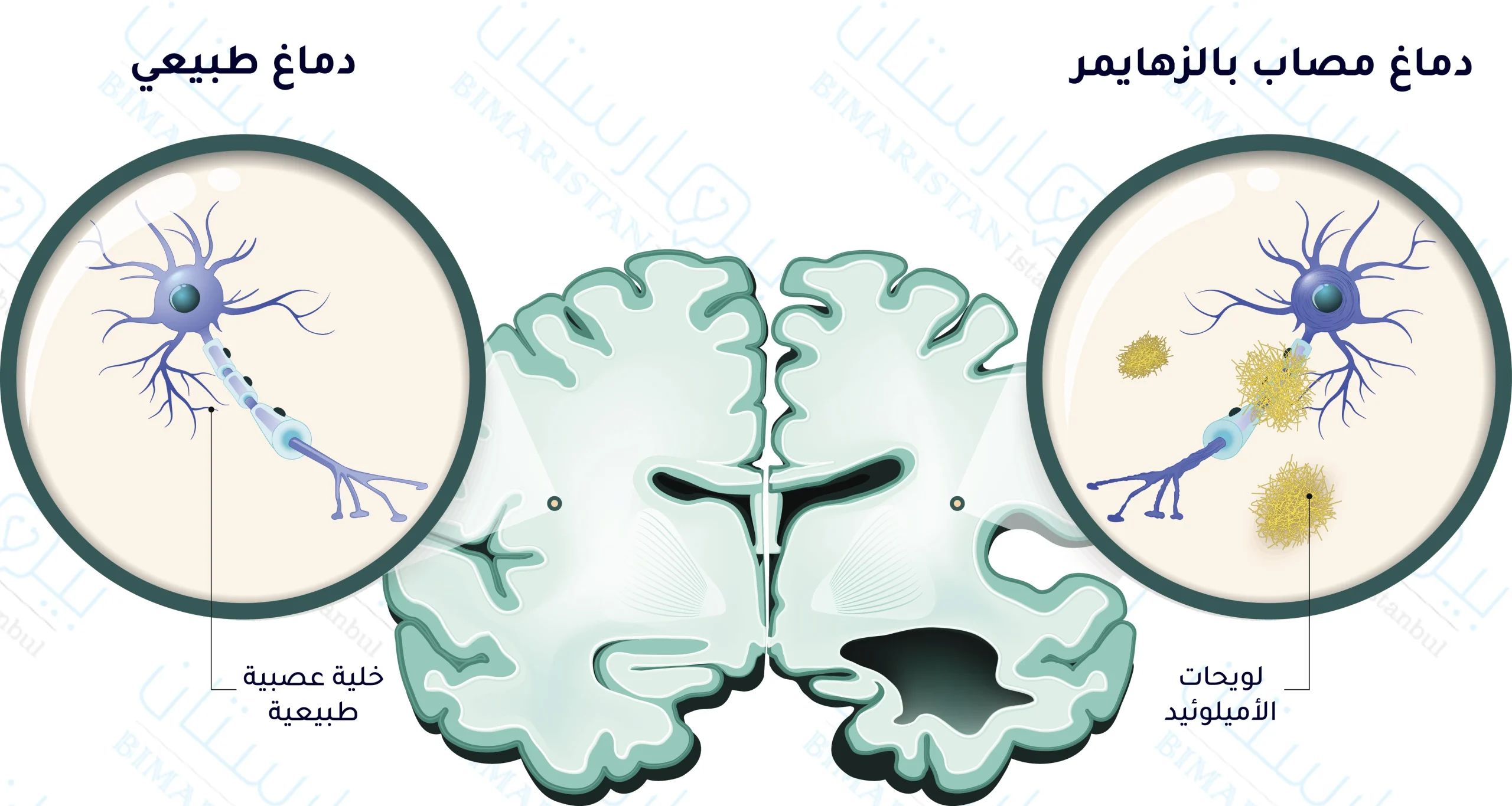 We observe the formation of amyloid plaques on nerve cells and the shrinkage of neuronal matter in the brain of a young man with early Alzheimer's.