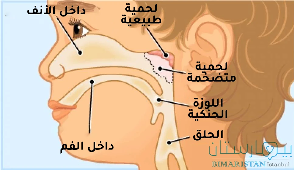 Image showing the location of the nasal polyps and enlargement of the nasal polyps