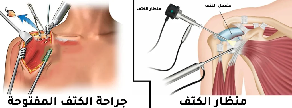 رسم توضيحي يقارن بين الجراحة المفتوحة واستخدام المنظار في عملية قطع وتر الكتف